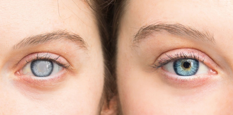 signs of cataracts