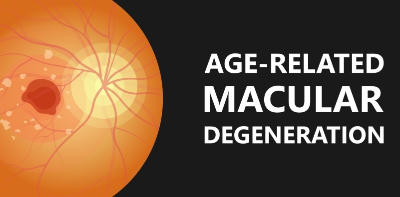 A graphic depicting the inner eye with age-related macular degeneration with the text ‘Age-related macular degeneration’ in white on a black background.]