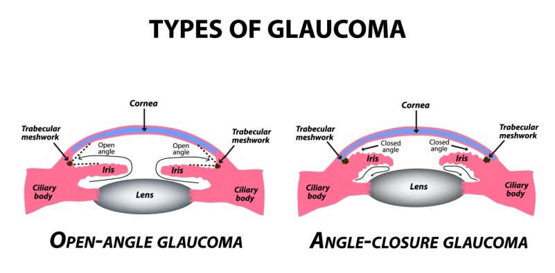 A diagram comparing the differences between open-angle glaucoma and angle-closure glaucoma