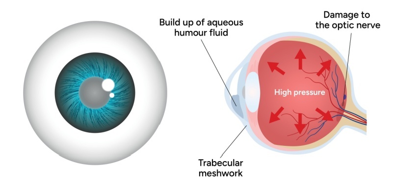 A diagram of glaucoma affecting eye health