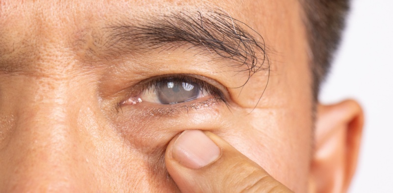 A close up of a man with a cataract, with his finger pointing towards his eye.