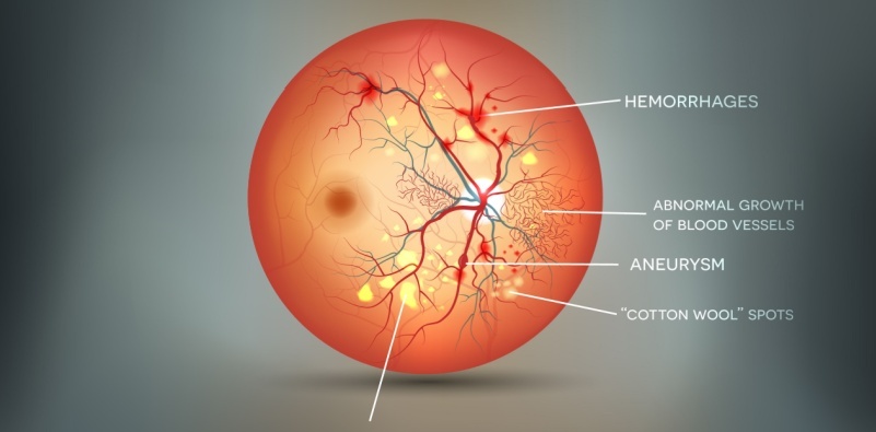 A diagram of the inside of an eye with diabetic retinopathy.